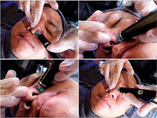 海菲秀+探索皮秒雷射”一次就見效😍30天後毛孔痘疤真的變縮小變平👍👍👍