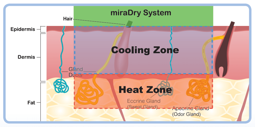 miraDry清新微波冷卻系統確保安全無虞、降低副作用